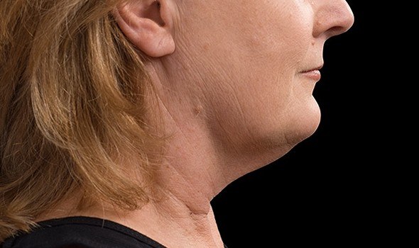 Double Chin Treatment, Woman — after