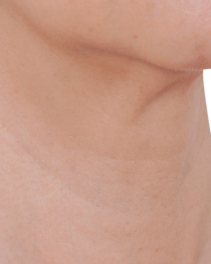 Neck Treatment, Woman — after