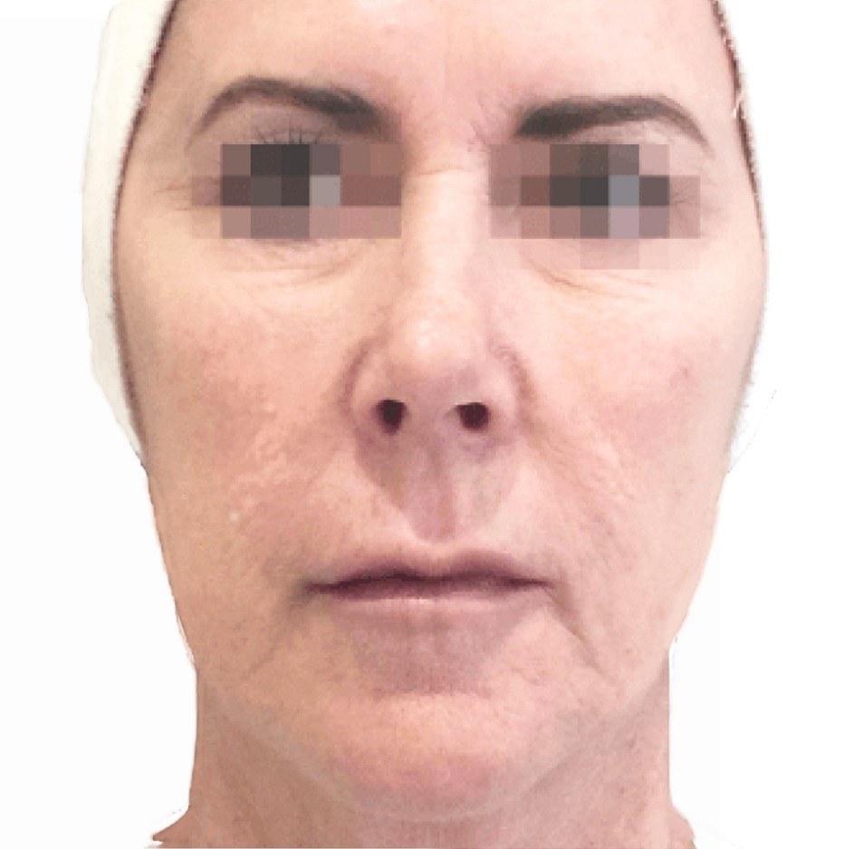 Facial Treatment, Woman — after