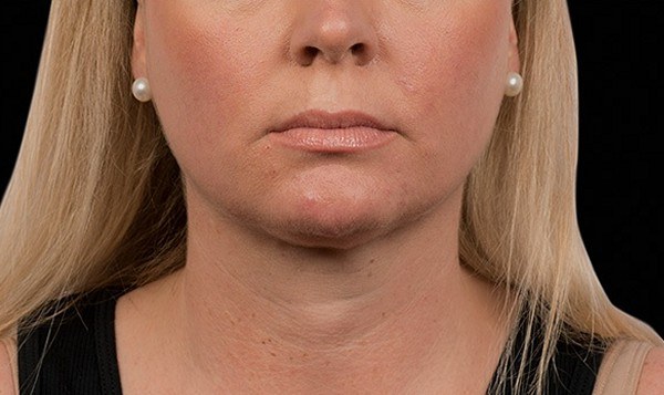 Chin Treatment, Woman — after