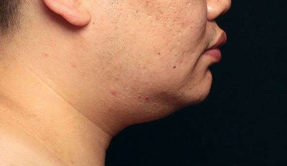 Chin Treatment, Man — after