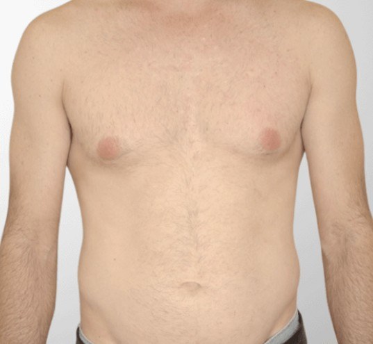 Chest Laser Hair Removal — after