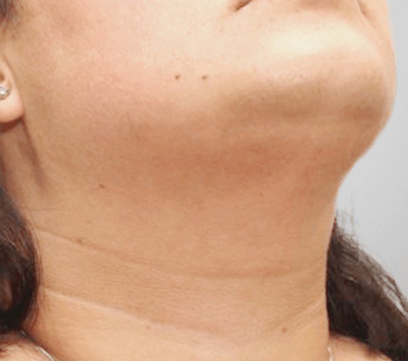 Facial Hair Removal for Women — after