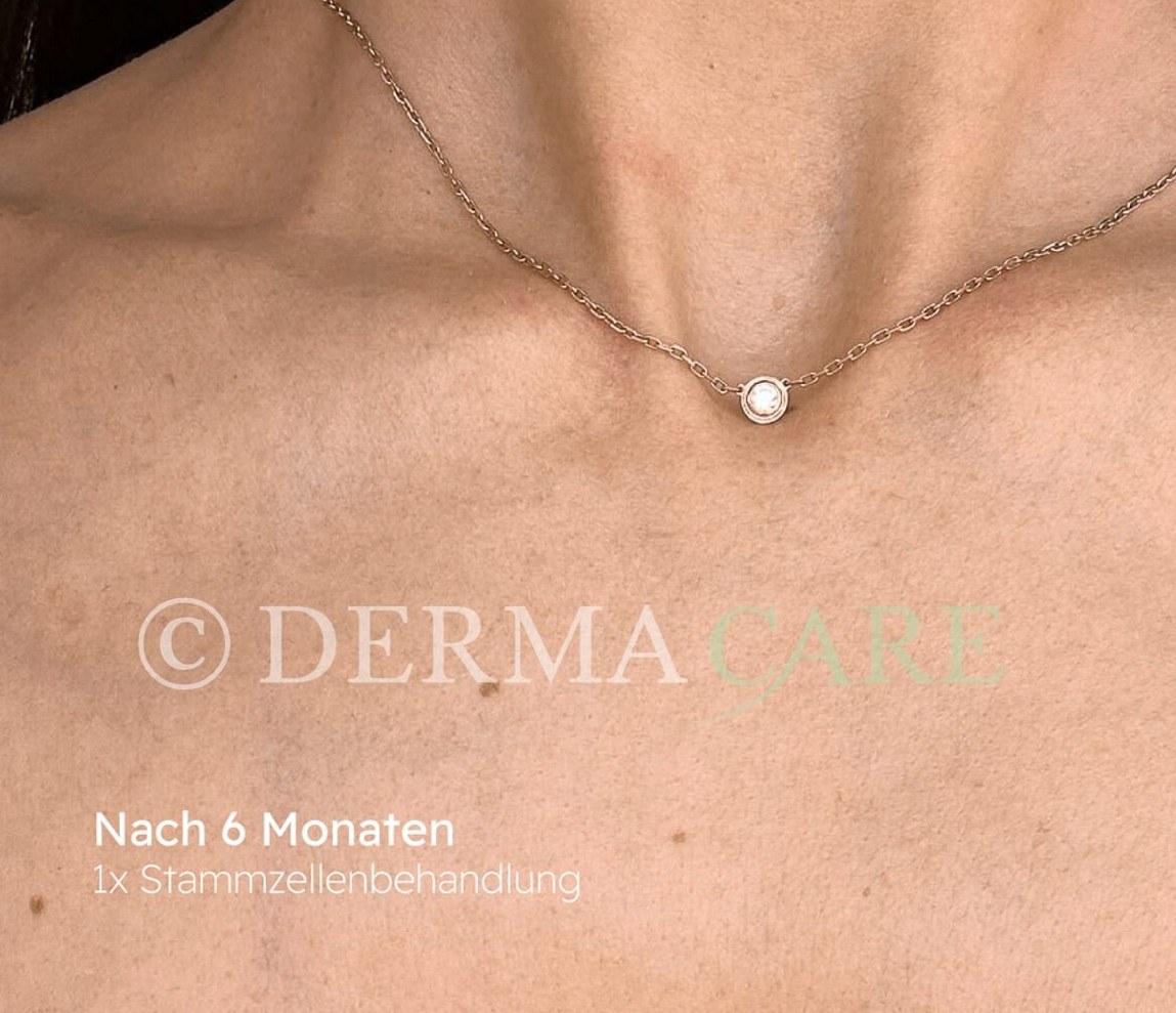 Décolletage Skin Rejuvenation with Stem Cells — after