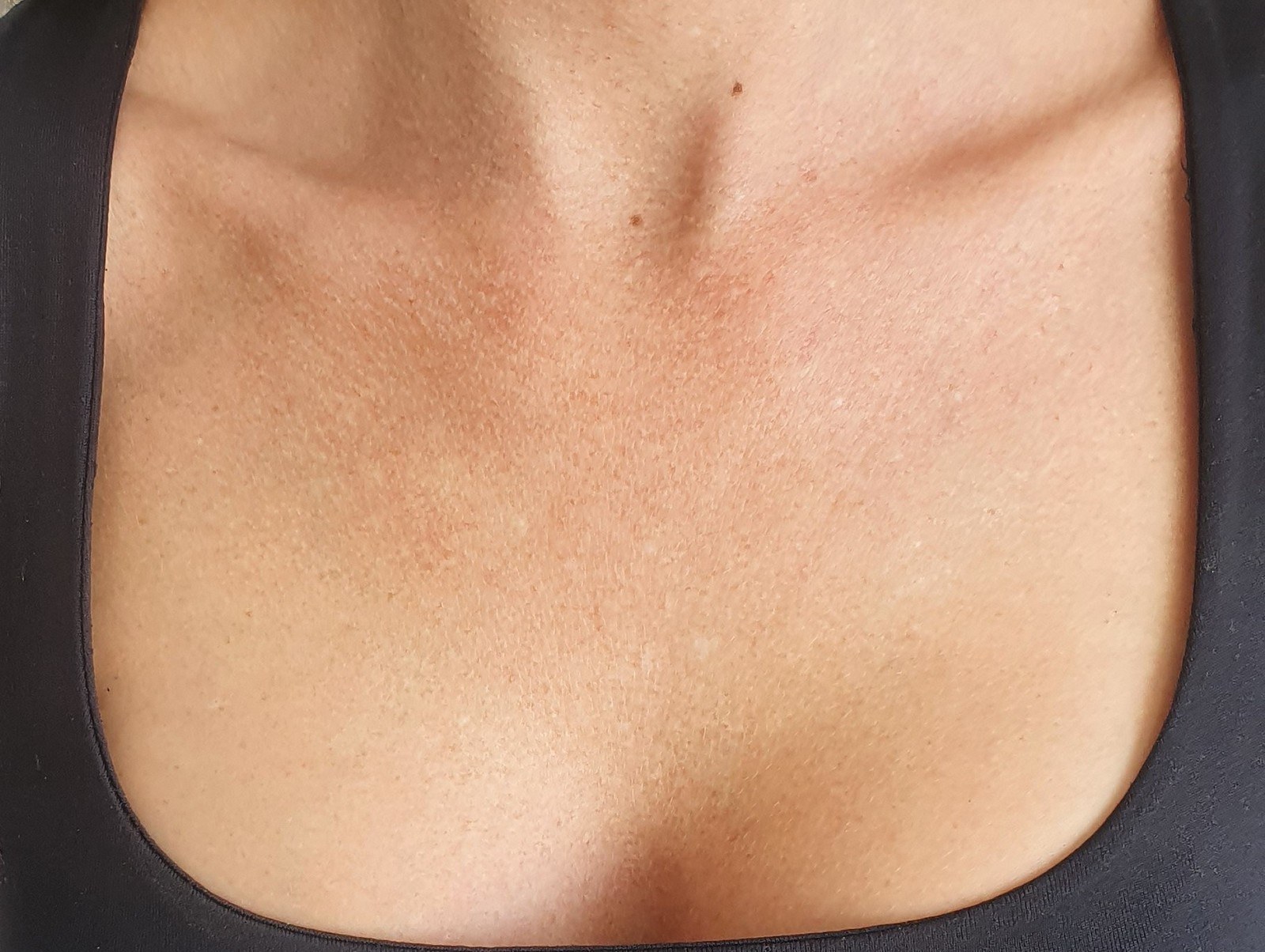 Décolletage Treatment with Collagen Filler — after
