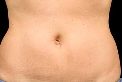 First Abdomen Treatment, Woman — after
