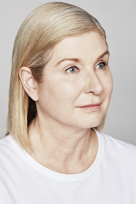 Thread Lift and Hyaluronic Filler — after
