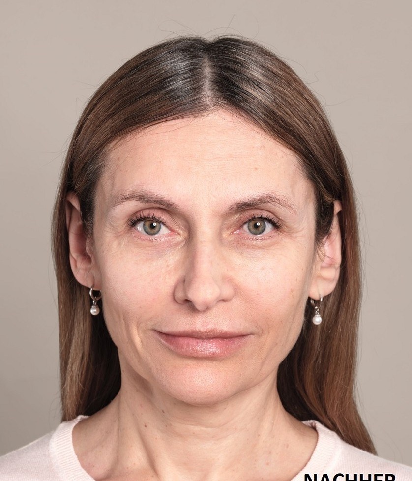 Wrinkle Treatment with Hyaluronic Acid in Vienna at Dermacare — after