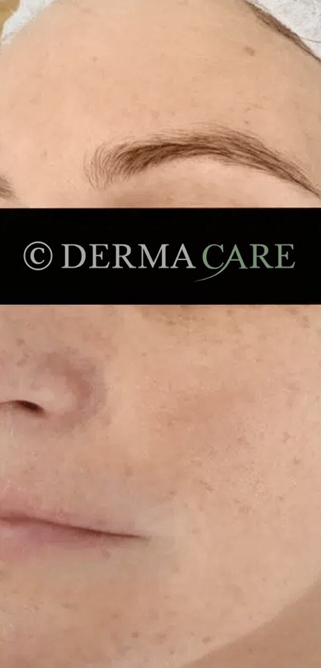 Face PQAge Peel — after