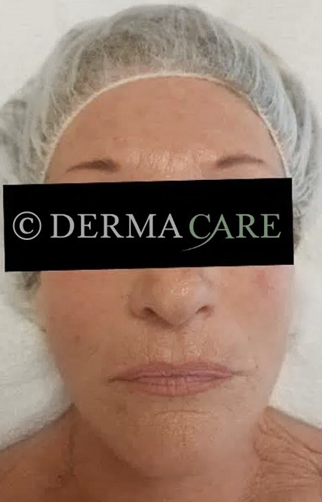 Face PQAge Peel — after