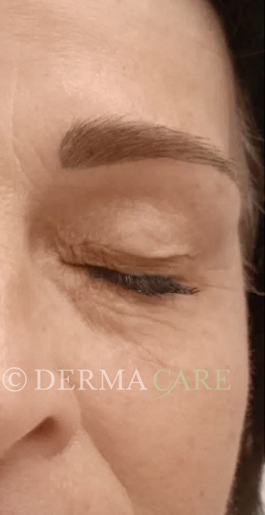 Face PQAge Peel — after