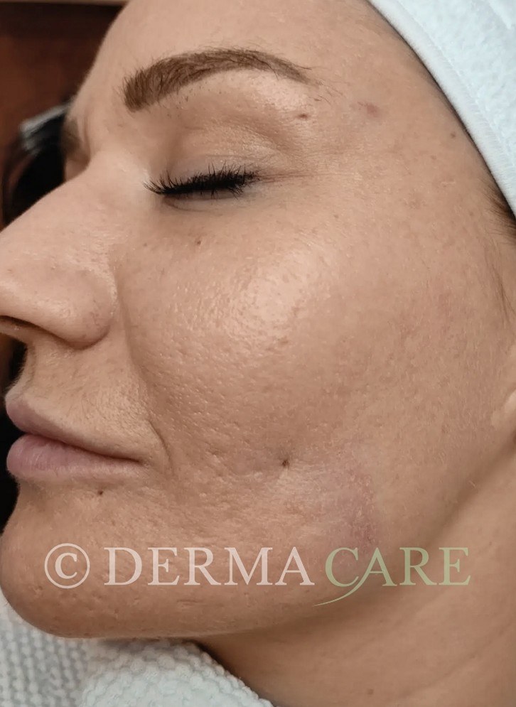 Face TCA Peel — after