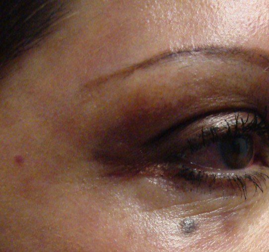Skin Tightening of Eye Wrinkles with CO2 Laser — after