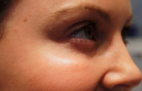 Crow's Feet (Periorbital Lines) — after
