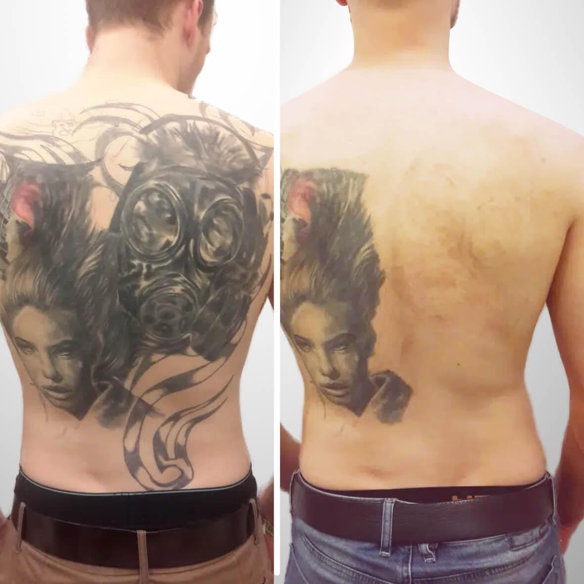 Tattooentfernung eines Cover Up mit viel Farbe — nachher