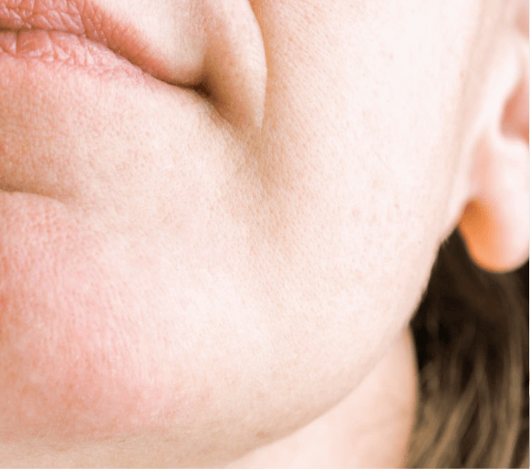 Facial Hair Removal for Women — after
