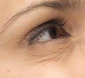 Periorbital Lines — after