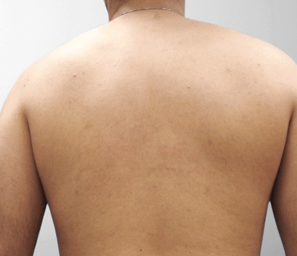 Back Hair Removal — after