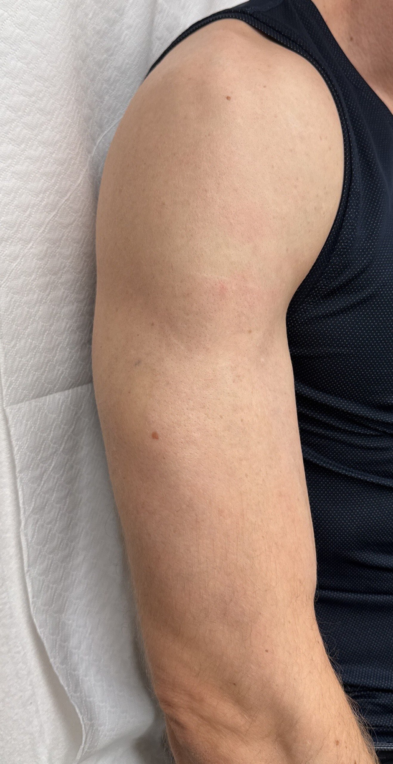 Schwarzes Tattoo am Arm — nachher