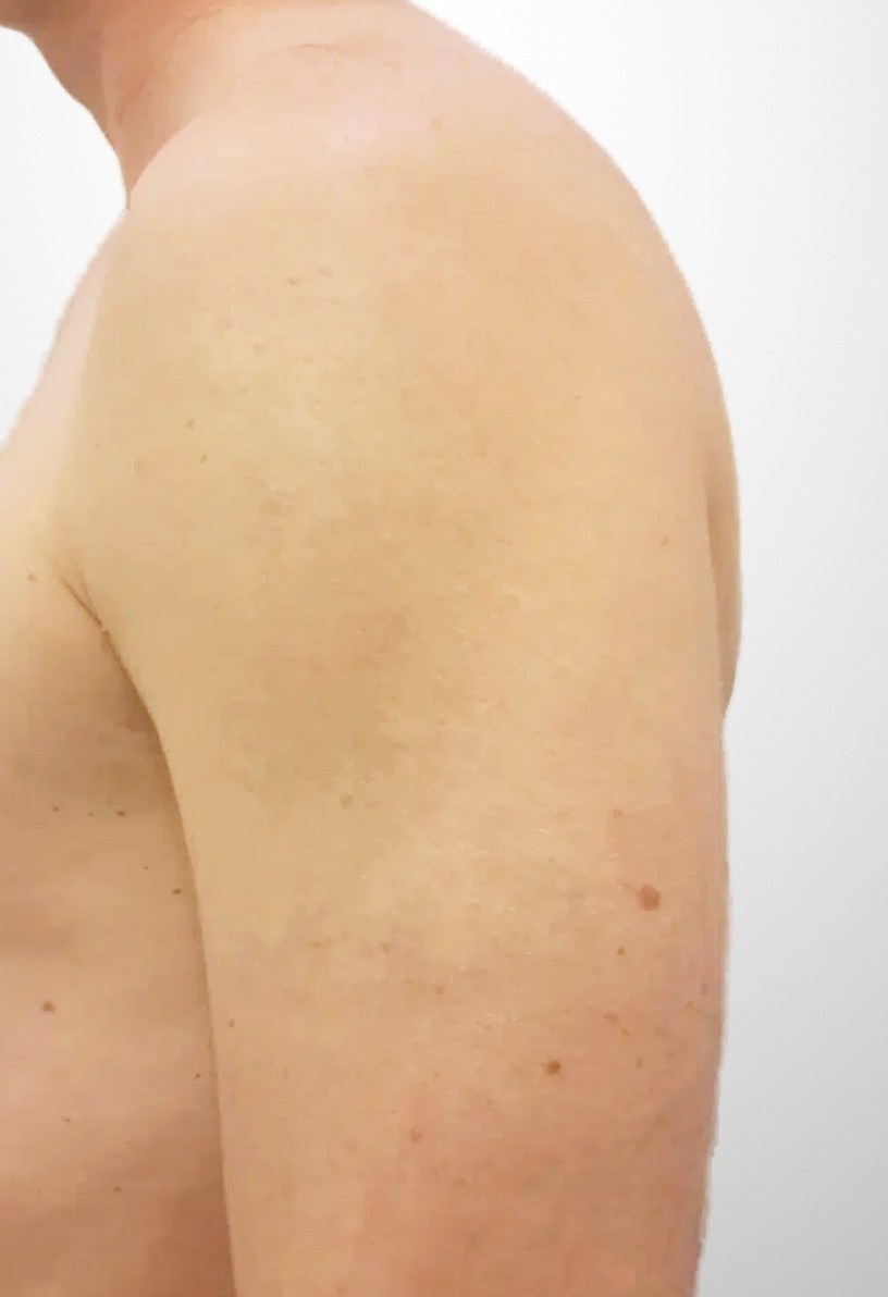 Schwarzes Tattoo am Oberarm — nachher