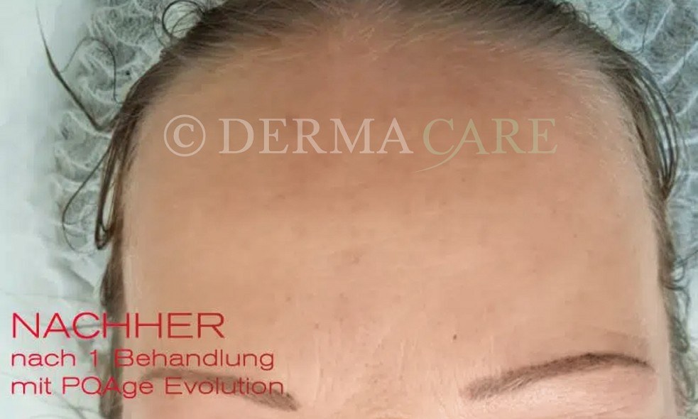 Forehead PQAge Peel — after