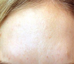 Forehead Lines — after