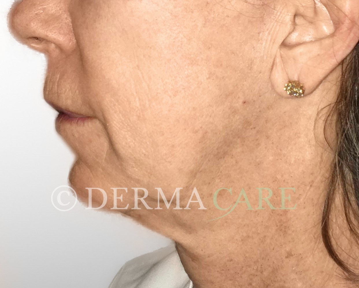 Neck Tightening — after