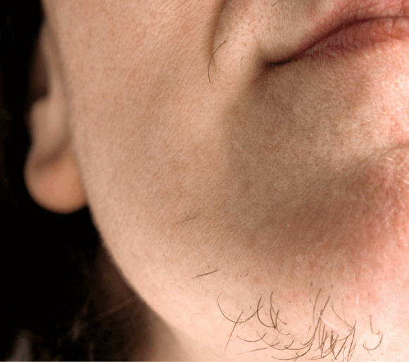 Facial Hair Removal for Women — before