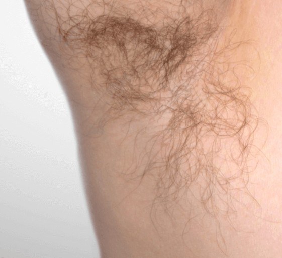 Underarm Hair Removal — before