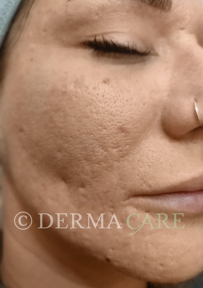 Acne TCA Peel — before