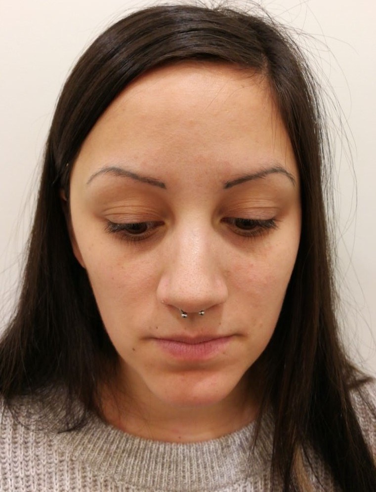 Eyebrows before and after 2 treatments — before
