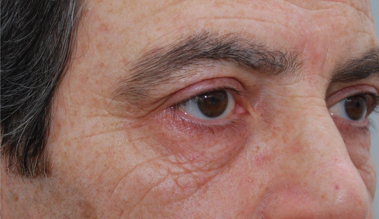 Treating Eye Wrinkles with Laser — before