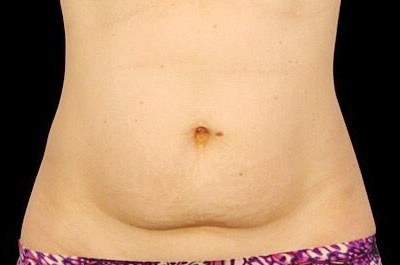 Abdomen Treatment, Woman — before