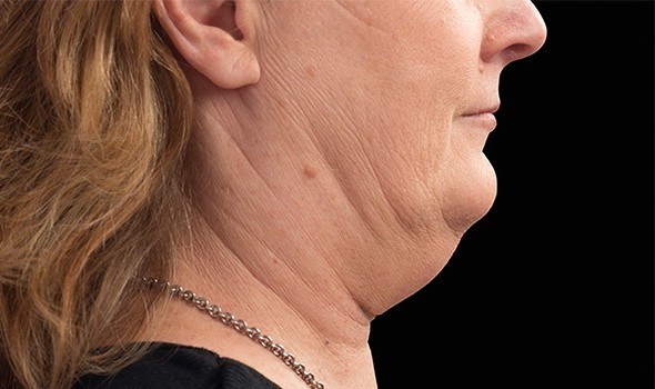 Double Chin Treatment, Woman — before