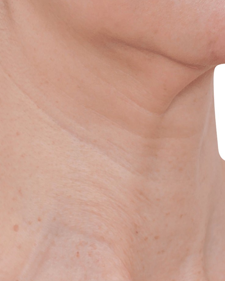 Neck Treatment, Woman — before