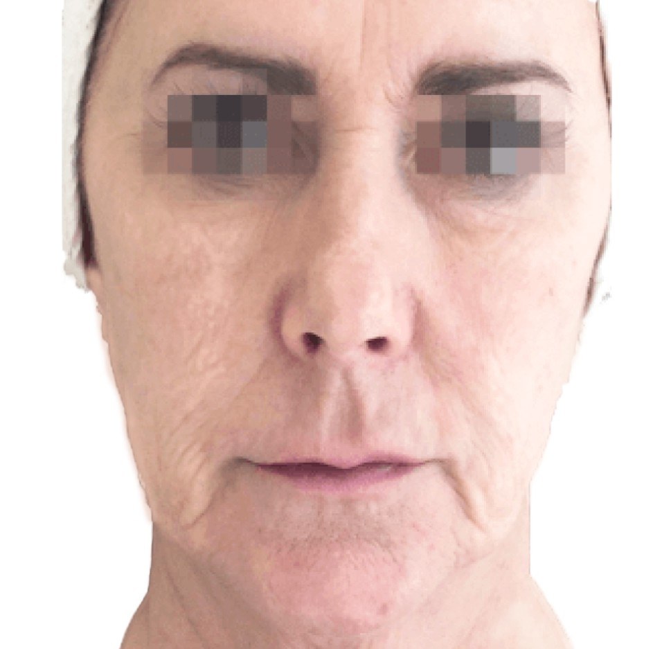 Facial Treatment, Woman — before