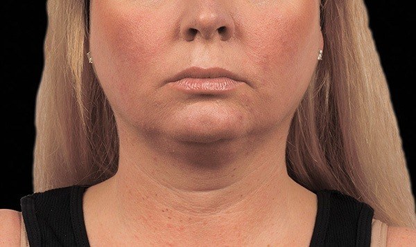 Chin Treatment, Woman — before
