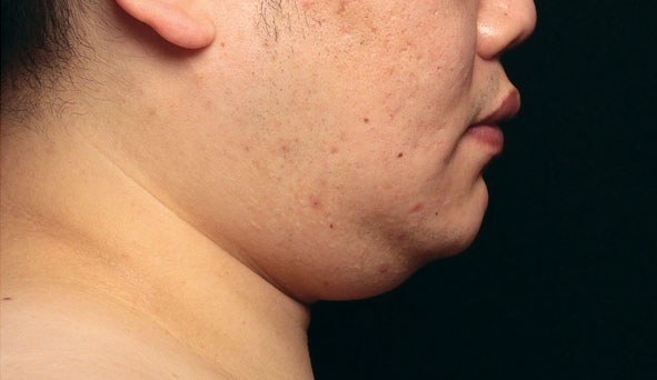 Chin Treatment, Man — before