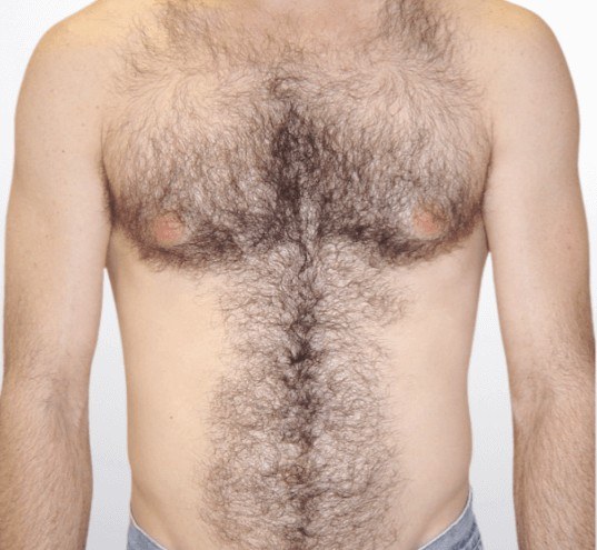 Chest Laser Hair Removal — before