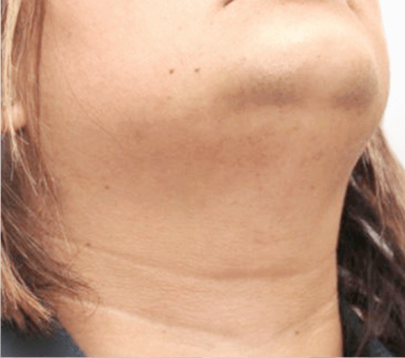Facial Hair Removal for Women — before