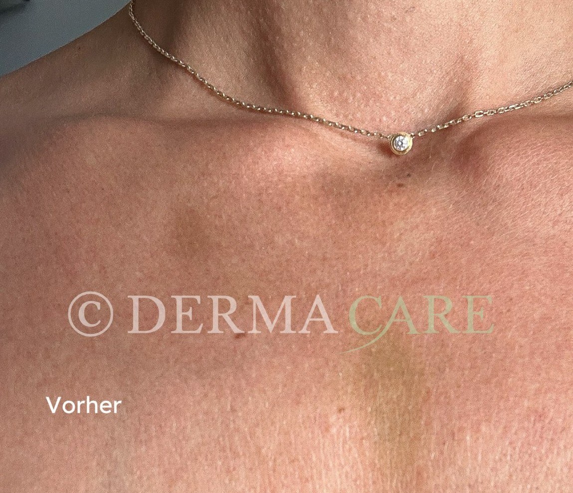 Décolletage Skin Rejuvenation with Stem Cells — before