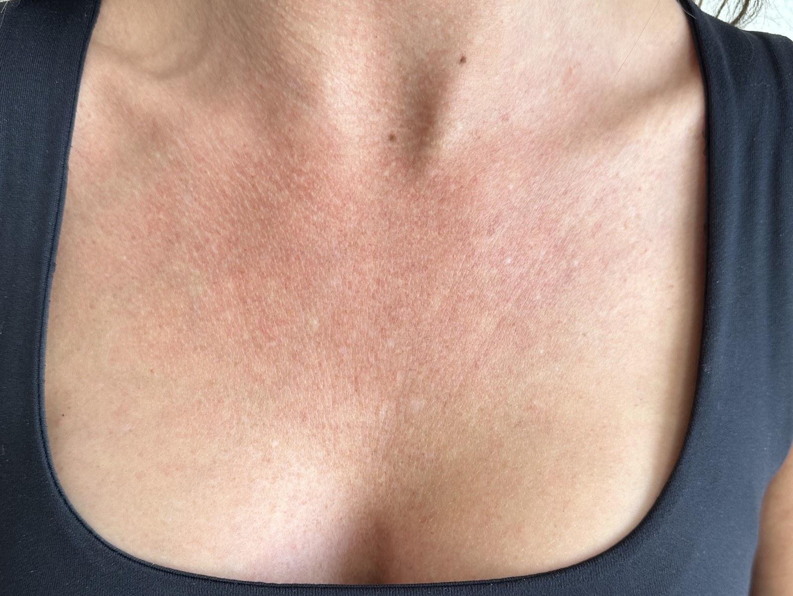 Décolletage Treatment with Collagen Filler — before