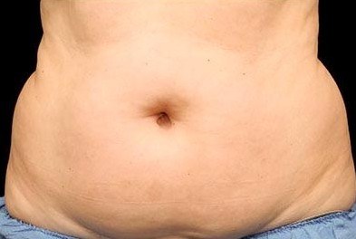 First Abdomen Treatment, Woman — before