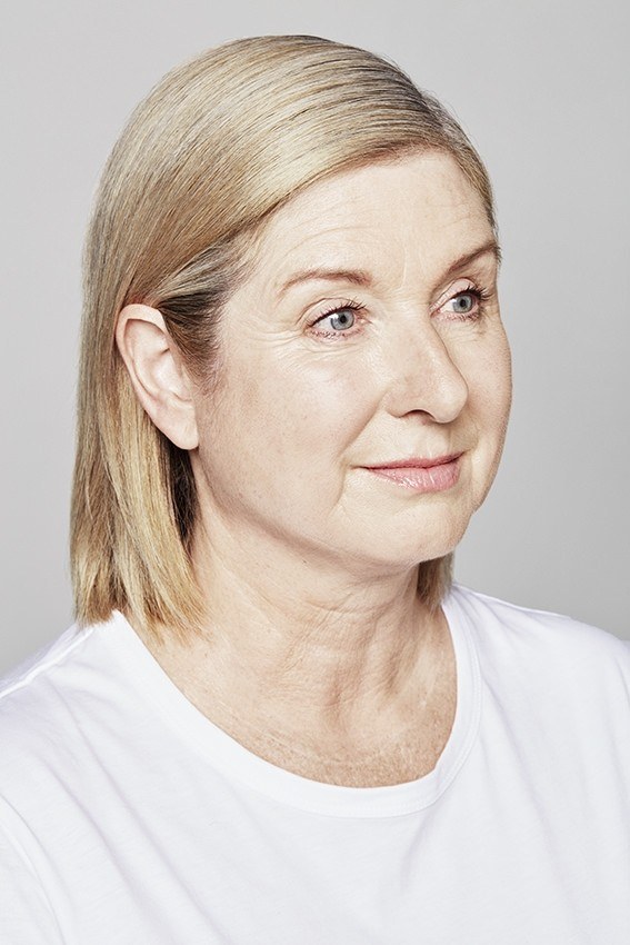 Thread Lift and Hyaluronic Filler — before