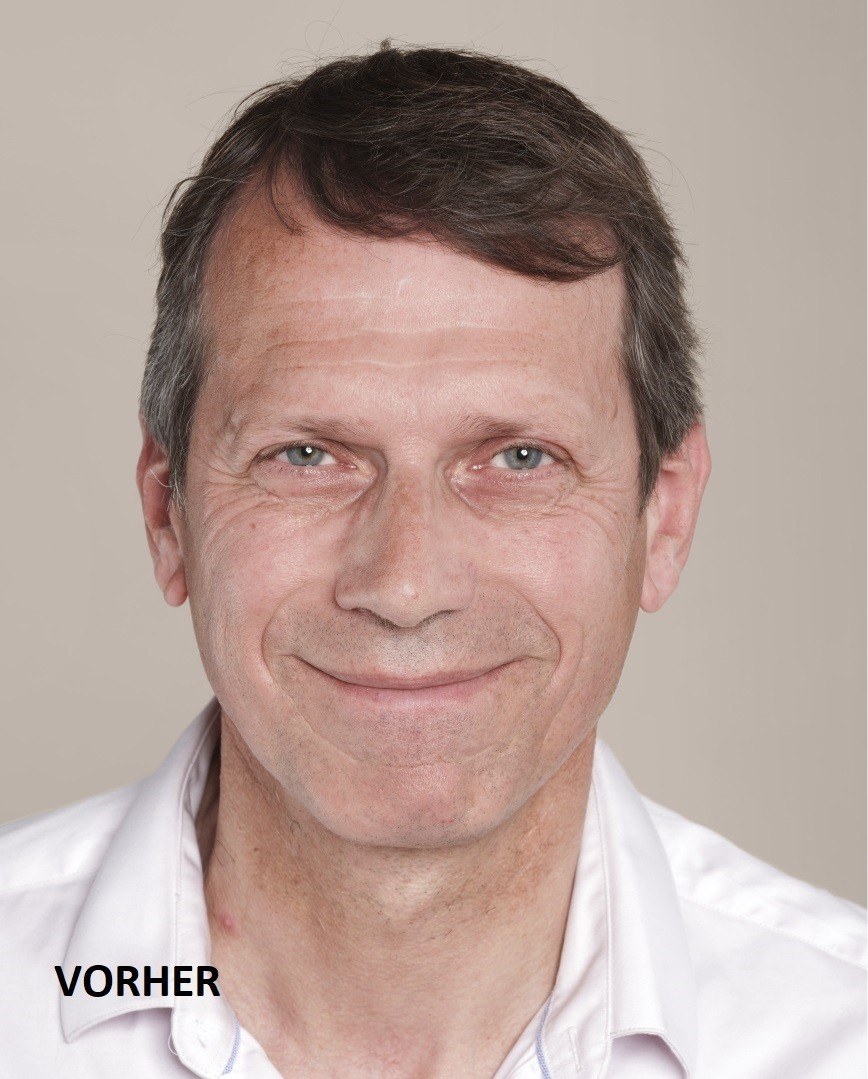 Wrinkle Treatment with Filler on a Man — before