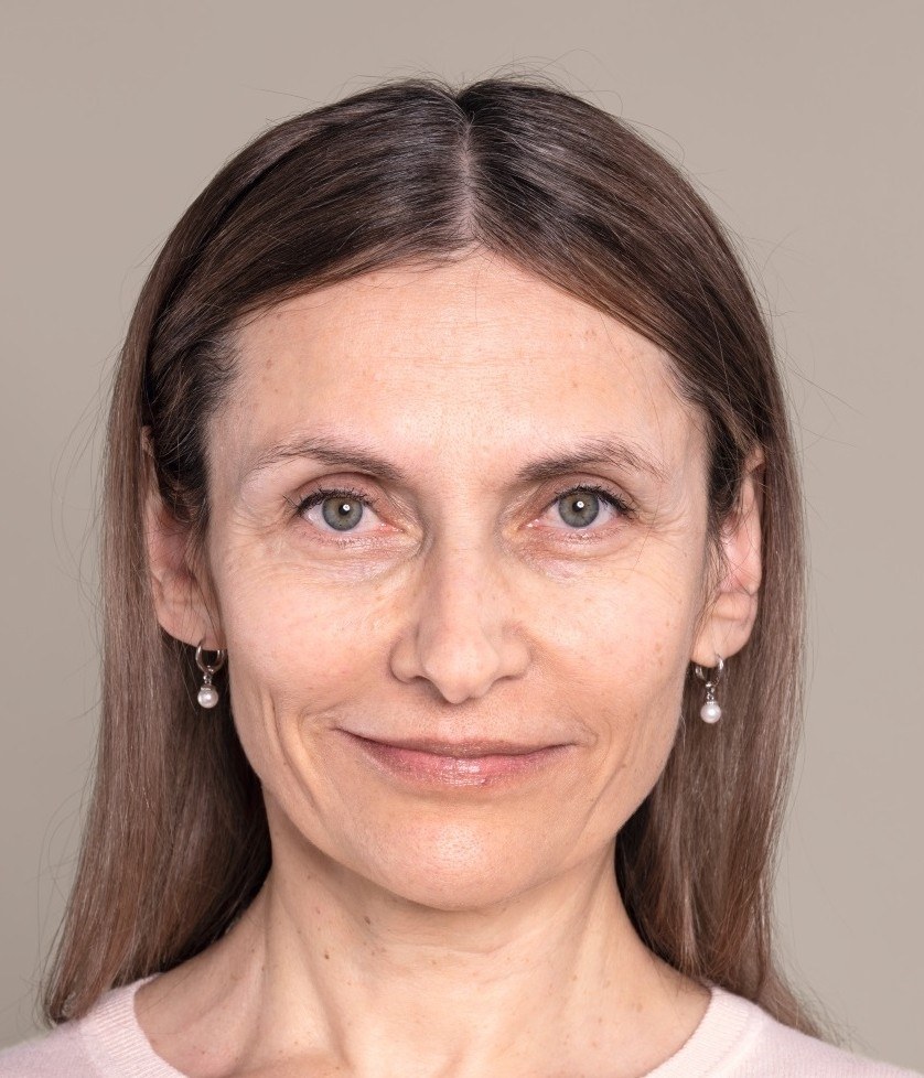 Wrinkle Treatment with Hyaluronic Acid in Vienna at Dermacare — before