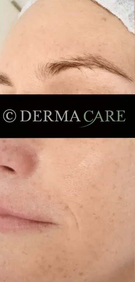 Face PQAge Peel — before