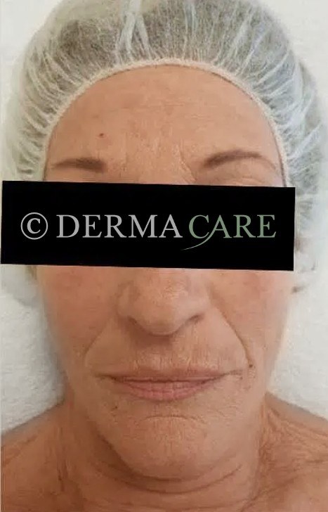 Face PQAge Peel — before