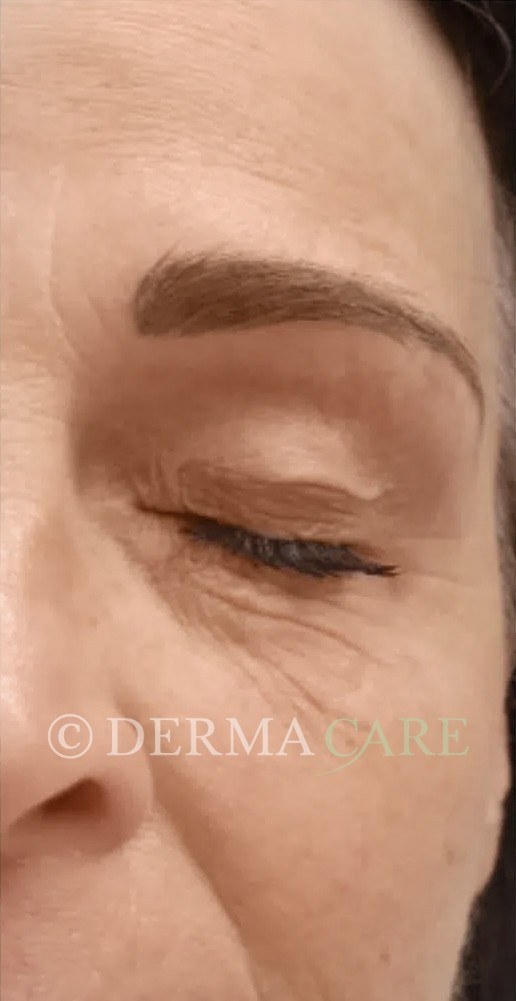 Face PQAge Peel — before