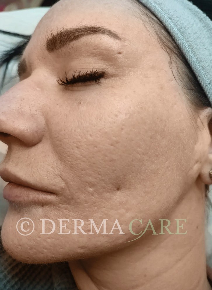Face TCA Peel — before